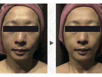 ニュイブラーシュ(nuit blanche)/最新型ハイパーナイフ６で若返る