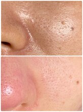 ソート(THOUGHT)/毛穴エクストラクションtete式