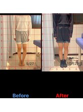 松戸駅前鍼灸院 整骨院/XO脚矯正の経過発表