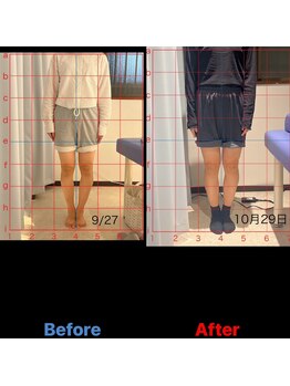 松戸駅前鍼灸院 整骨院/XO脚矯正の経過発表