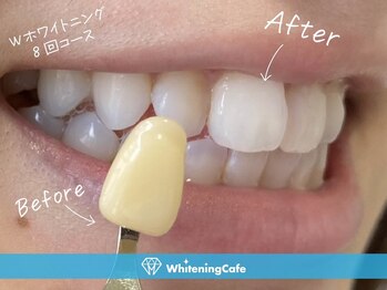 ホワイトニングカフェ 札幌東急百貨店(WhiteningCafe)/◎歯のホワイトニング施術写真◎