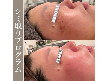 シンデレラ しみケア(Cinderella)/シミケアプログラム