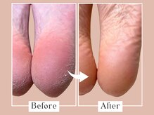 ベベ(Bebe)/女性/ガサガサ悩み