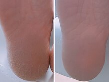 かかとのガサガサや足裏の角質ケアはお任せ下さい♪