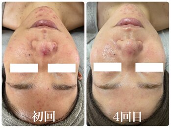 エステサロンブランシュ(Esthe salon Blanche)/ハーブピーリングでニキビケア