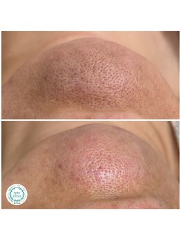 ソート(THOUGHT)/毛穴エクストラクションtete式