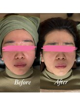 ホルバール 佐賀店(Hallbar)/ボタニカルハーブピーリング