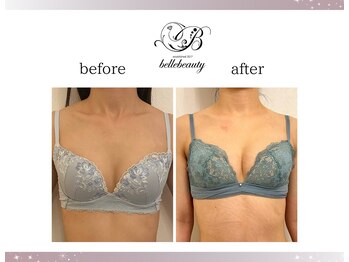 ベルビューティー(belle beauty)/バストアップ◇症例◇