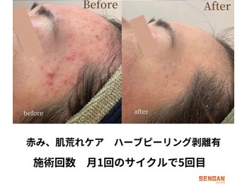 洗顔サロン 池袋(SENGAN)/剥離ハーブピーリング　