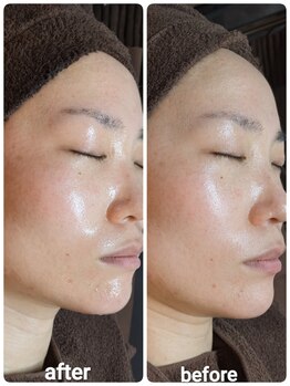 ウララ(ulala)/セラピールビフォアフ