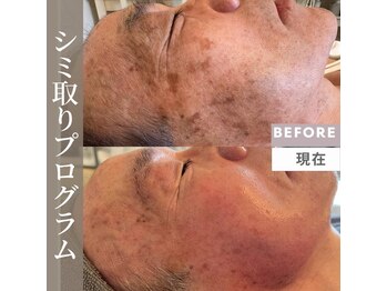 シンデレラ しみケア(Cinderella)/シミケアプログラム