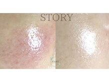 ストーリー 岐阜店(STORY)/ハーブピーリング専門店STORY