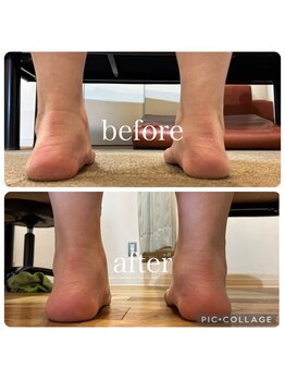 ポドウオーク(PODO WALK)/足首の変形