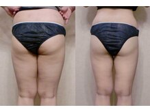 エメ 心斎橋(Aimer)/筋膜リリース痩身エステ