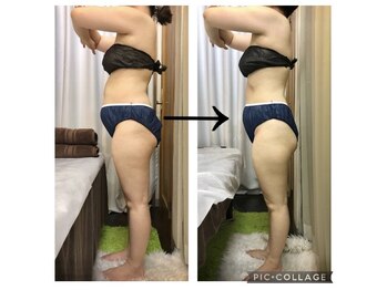 アンジェリーク(ANGELIQUE)/脂肪冷却＋美骨盤ダイエット