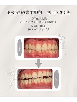 プラスビーセルフ(+b self)/ホワイトニングビフォーアフター