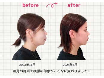 ナチュラルハリー(NaturalHarry)/当サロン自慢の経絡小顔施術!