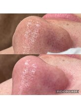 ルナート(Lunart)/毛穴洗浄／毛穴ケア