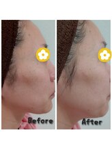 プロジェクトサン ムーンベル(PROjECTSuN Moonbell)/光フェイシャル＋ポレーション