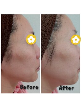 プロジェクトサン ムーンベル(PROjECTSuN Moonbell)/光フェイシャル+ポレーション