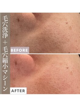 シンデレラ しみケア(Cinderella)/毛穴洗浄＋毛穴縮小マシーン