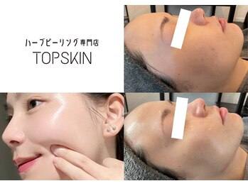 トップスキン 新宿(TOPSKIN)の写真/【当店先行導入*最新肌育ピーリング】ピンとハリ感!潤ツヤの水光肌へ◎春のダメージ肌も徹底改善☆