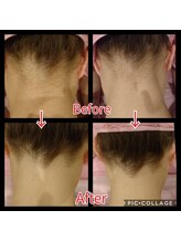 ドルチェヴィータ(DOLCE VITA)/うなじ脱毛