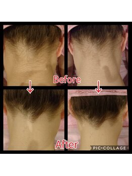 ドルチェヴィータ(DOLCE VITA)/うなじ脱毛