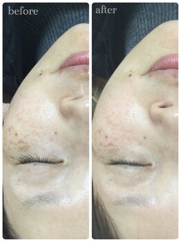 メイユール(MEILLEUR)/光フェイシャル1回