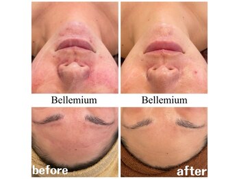 ベレミアム(Bellemium)/ニキビケア、赤み改善