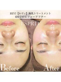 エスプリ 新宿店/ハーブピーリング新宿