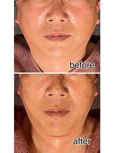 レイール(Reir)/ほうれい線タルミ改善！予防ケア