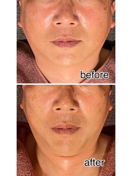 レイール(Reir)/ほうれい線タルミ改善!予防ケア