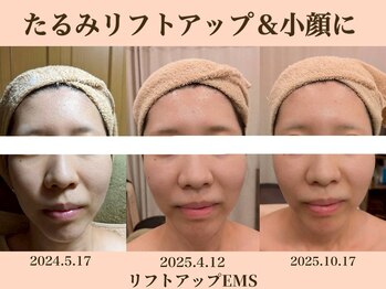 ラーナ(Lana)/リフトアップEMS BIFORE→AFTER