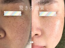 サロンドシエル カスガイ(Salon de Ciel kasugai)/驚きの効果のシミケア