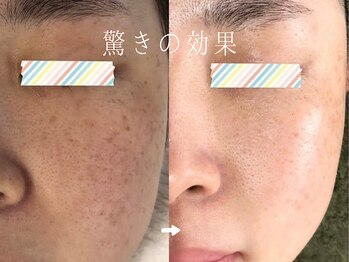 サロンドシエル カスガイ(Salon de Ciel kasugai)/驚きの効果のシミケア