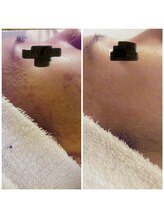 ダリア(DALIA)/肌荒れ・ニキビ