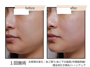 コンビンス(convince)の写真/【人生最高の私へ】挙式後も美しさが続く“肌育ブライダル”★ドレスに映える、圧倒的なハリ・艶・透明感