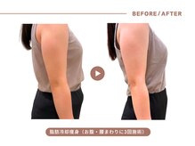 イエス マイサロン(yes My Salon)/脂肪冷却施術例