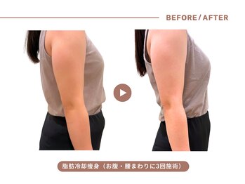 イエス マイサロン(yes My Salon)/脂肪冷却施術例