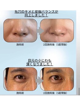 ココサロン(Coco Salon)/塗るボツリヌストキシン