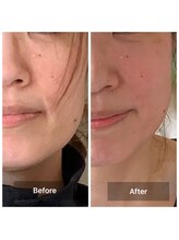 ヨサ パーク コアハート(YOSA PARK CORE HEART)/1回の効果