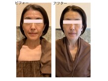 アクア エステティコ 亀有(ACQUA estetico)/シリカピーリング　1ヶ月メンテ