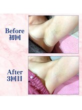 カラフル(caratful)/わき脱毛 Before After 