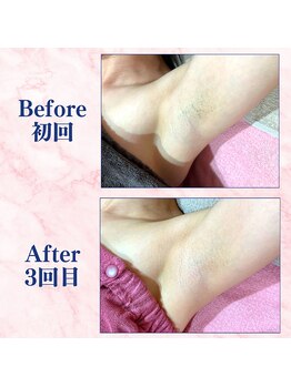 カラフル(caratful)/わき脱毛 Before After 