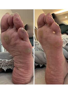 寺子屋ビューティーズ(寺子屋Beauty's)/痛いタコさんサヨナラ~