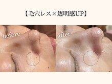 ドリームスパ 武蔵小杉店(DREAM SPA)/毛穴吸引＋水光ツヤ肌パック