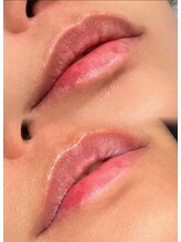 ライム 五反田(LIME)/ローマピンク｜黒ずみケア