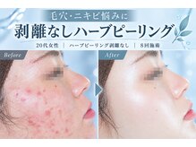 ライム 柏(LIME)の雰囲気（毛穴洗浄×ハーブピーリングでニキビ・毛穴を徹底ケア！#ハーブ）