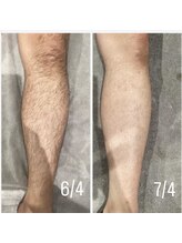 ネイチャー(Nature)&nbsp;足脱毛１回 変化写真